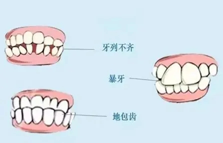 牙齒不齊會(huì)帶來哪些危害 | 成都義齒廠家